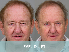 eyelid-lift
