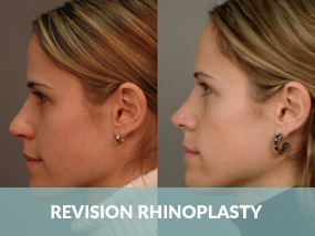 revision rhinoplasty