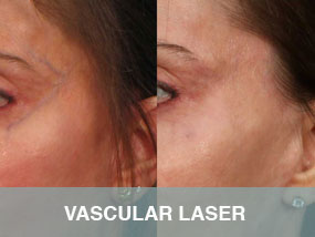 vascular-laser